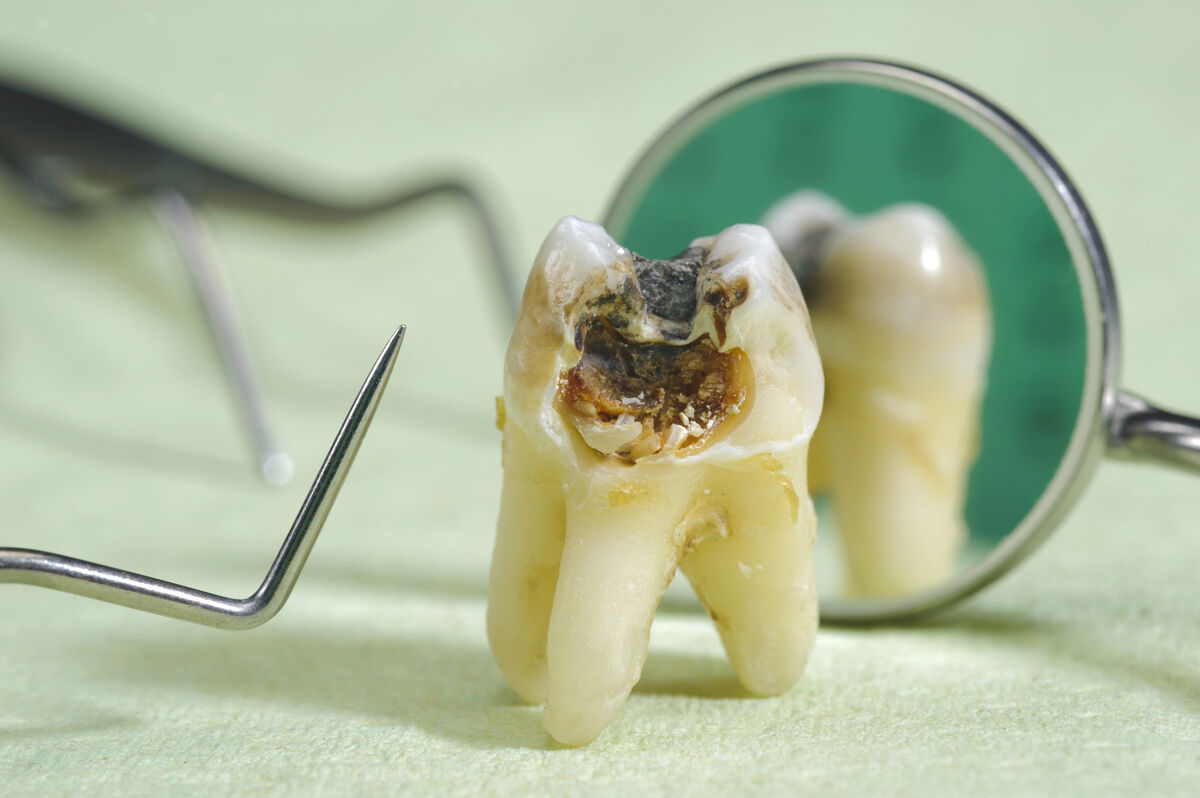 Cavity Treatment in 2026: Types, Cost & Prevention (NYC Guide)