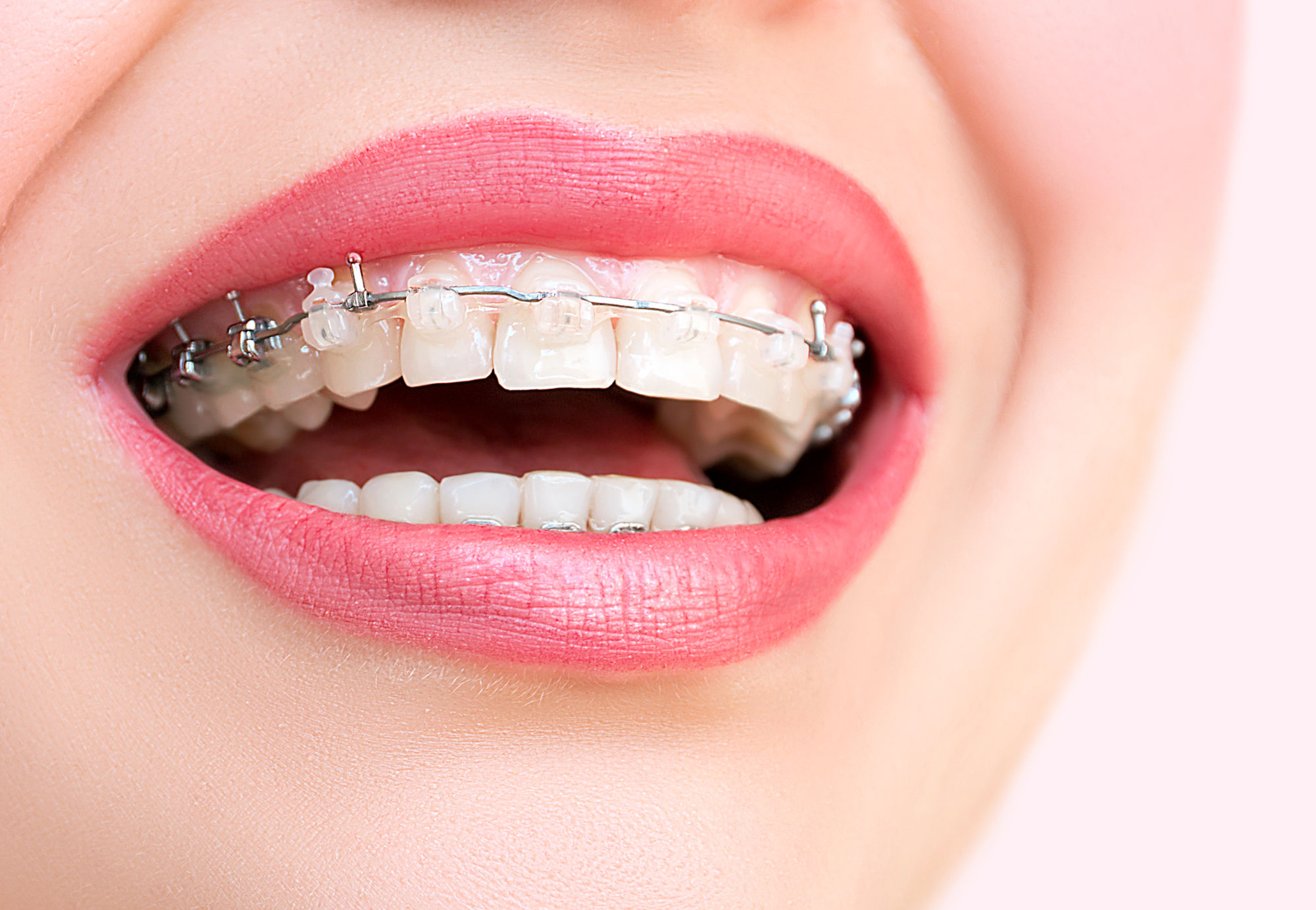 Ceramic Braces in 2026: Cost, Pros & Cons, and NYC Provider Guide