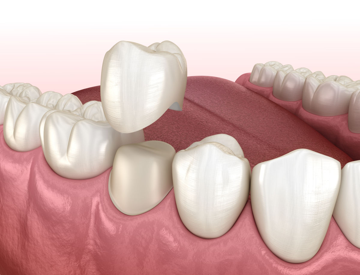 Dental Crowns in NYC: Types, Cost, Procedure & Insurance Guide (2026)