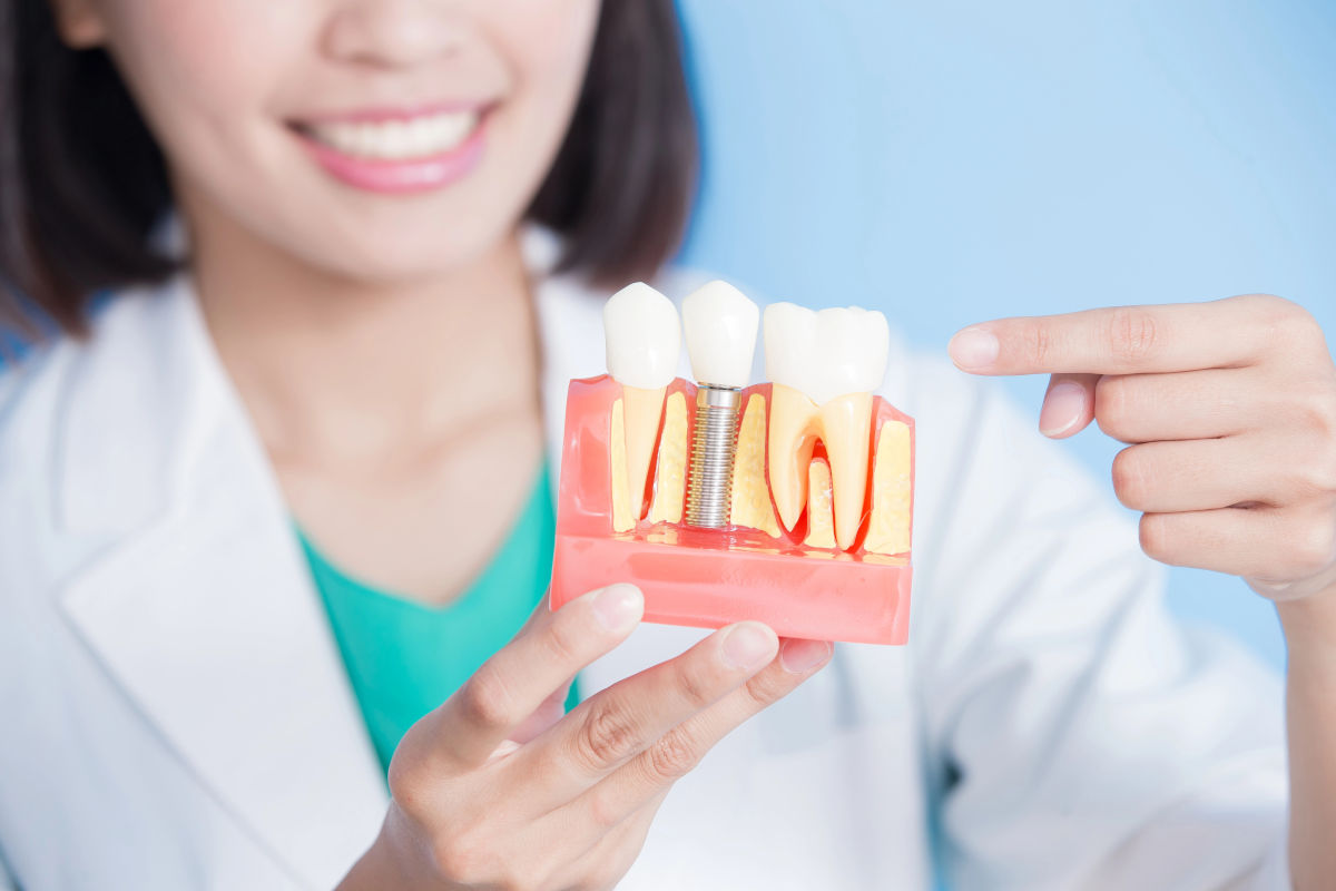 Dental Implants in NYC: Complete 2026 Guide (Types, Cost, Recovery)