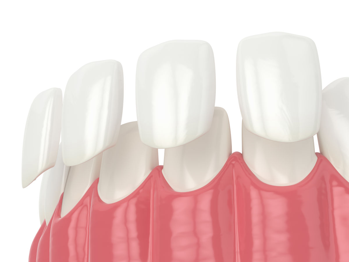 Dental Veneers in NYC: Cost, Types, Procedure & What to Expect (2026)