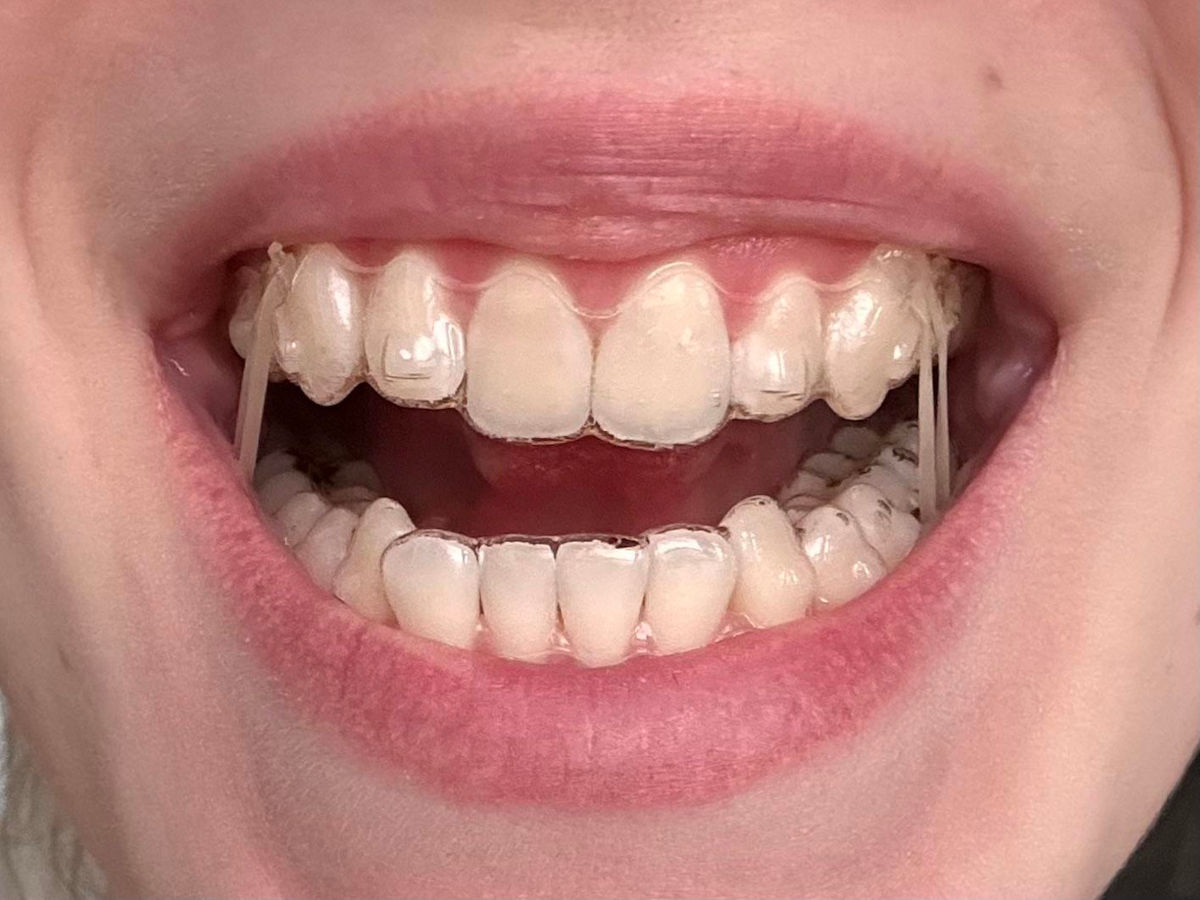 Invisalign With Elastics (Rubber Bands): Why, How, and What to Expect (2026)