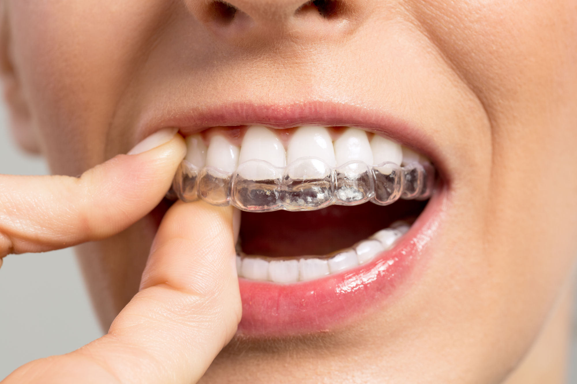 Invisible Braces in 2026: All Your Options Compared (NYC Guide)