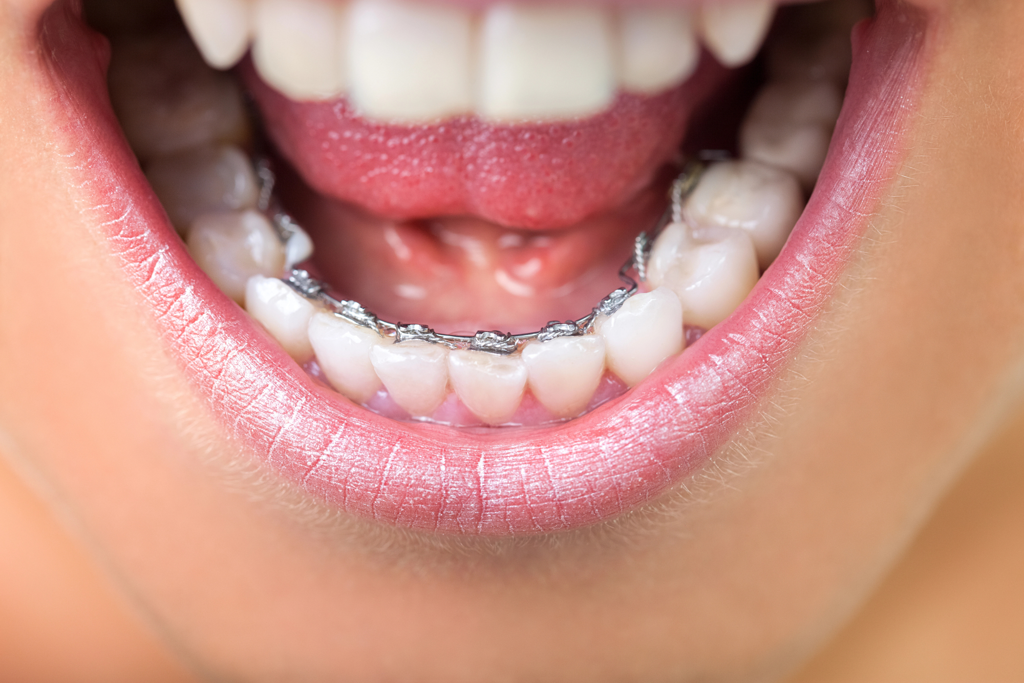 Lingual Braces: The Hidden Orthodontic Option (2026 Cost & Guide)