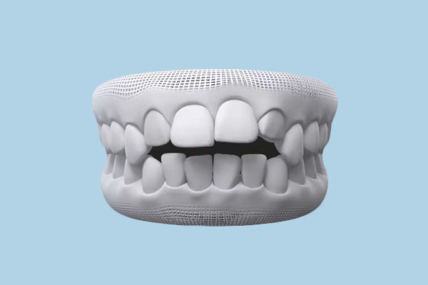 Open Bite Correction in 2026: Causes, Treatments & Costs (NYC Guide)