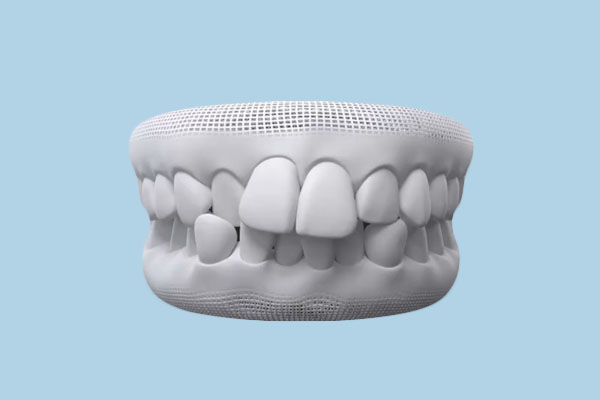 How to Fix Overlapping Teeth: All Treatment Options Compared (2026)