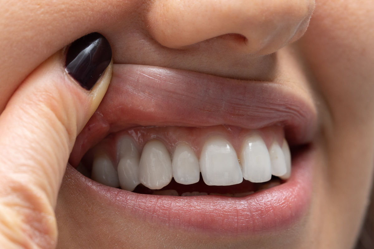 Periodontitis: Symptoms, Stages & Treatment Options (2026 NYC Guide)