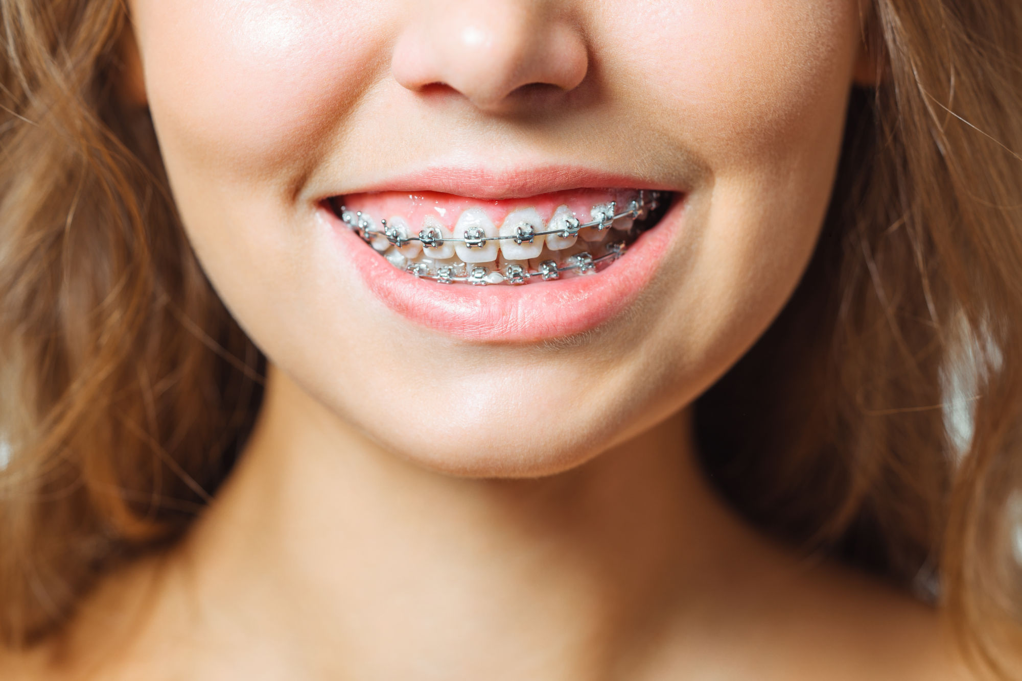 Types of Braces in 2026: Metal, Ceramic, Lingual, Invisalign Compared (NYC Guide)